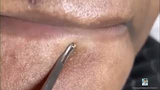 Ultimate Pimple Popping 2024 Extreme Acne Extractions [upl. by Cynthy198]