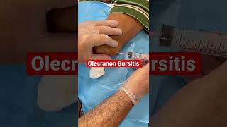 Olecranon Bursitis the fluid is taken out just like from a balloon by a Hand Surgery Specialist [upl. by Sugar]