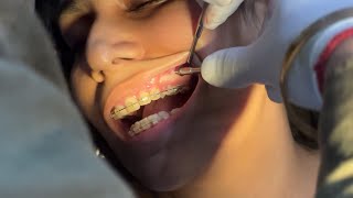 Orthodontic implant placement [upl. by Domash]