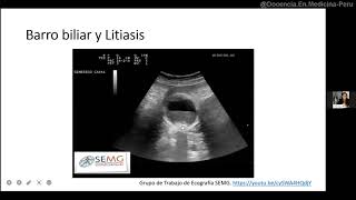 Vesícula biliar Ecografía normal y con litiasis [upl. by Akaya269]