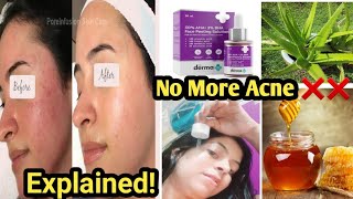 Secrets Revealed Acne Reduce ExplainedHow To Reduce pimple Causes  Prevention [upl. by Aidroc905]