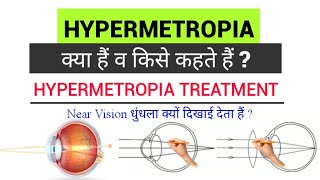 Hypermetropia  Hypermetropia in hindi  Hypermetropia Treatment  पास की नजर कम क्यों होती हैं [upl. by Derinna]