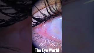 conjunctival cyst [upl. by Rosenfeld534]