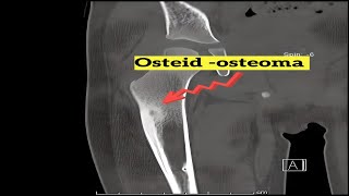 Osteoid Osteoma Insights [upl. by Derrek]