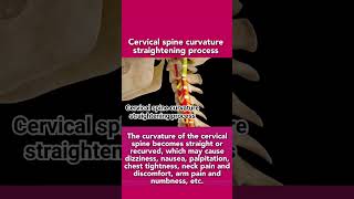 Cervical spine curvature straightening processcervical spine subscribe like shortvideo [upl. by Earissed271]