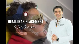 Head gear placement in orthodontics facebow high pullactivator in class II skeletal Dr Amr Asker [upl. by Aiken566]