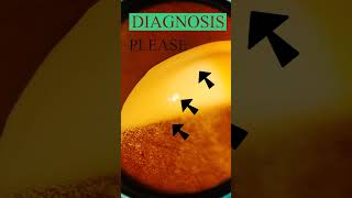 Diabetic retinopathy  Vitreous  Hard exudates  Fundus  Short Video 193 [upl. by Anne-Corinne]