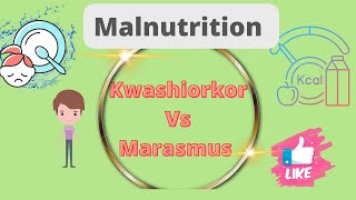 Kwashiorkor vs Marasmus DefinationDifference Malnutrition Nursing notes [upl. by Callida309]