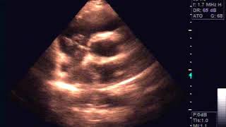 Echocardiography of Hydatide cyst in the interatrial septum [upl. by Lekcar]