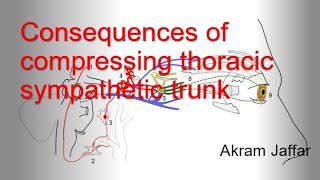 Consequences of compressing the thoracic sympathetic trunk [upl. by Pry]