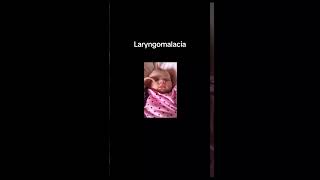 Laryngomalacia [upl. by Luapnoj924]