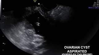 ULTRASOUND GUIDED ASPIRATION OF OVARIAN CYST ALNOOR DIAGNOSTIC CENTRE prof Dr Safdar Ali Malik [upl. by Rivalee]