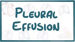 Pleural Effusion  causes symptoms diagnosis treatment pathology [upl. by Eddra]