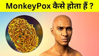 MonkeyPox कैसे होता हैं  New pandemic Alert [upl. by Torrey]