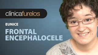 Eunice Craniofacial surgery frontal encephalocele [upl. by Nolad]