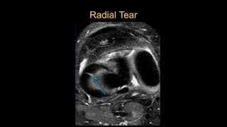 TMT MRI Knee Meniscal Tears by Dr Srijita Ghosh [upl. by Cleland]