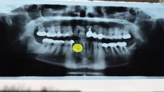 falsche diagnose keine fibroisierende osteomyelitis [upl. by Erny205]