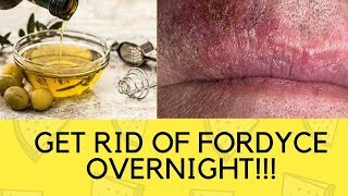 How To Get Rid Of Fordyce Spots On Lips And Shaft Overnight Naturally Fast At Home [upl. by Alcina]