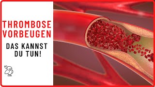 ✅THROMBOSEPROPHYLAXE LEICHT GEMACHT✅ 9 einfache Tipps wie du einer Thrombose vorbeugen kannst [upl. by Cynara401]