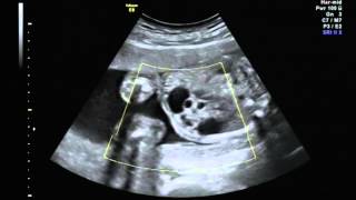 Multicystic kidney disease unilateral MCKD with a normal contralateral kidney Potters type 2 [upl. by Crane943]