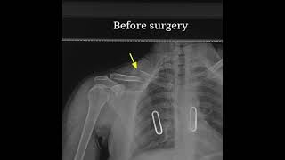 Clavicle Fracture Xray Before After Surgery [upl. by Htrahddis]