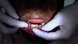 Removable Denture Clasp Repair Part 1 [upl. by Eecyal]