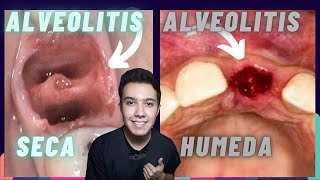 ALVEOLITIS HUMEDA Y SECA👅 CAUSAS TRATAMIENTO INFECCION DESPUES de una EXTRACCION DENTAL 🦷 [upl. by Diraj]