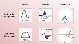 Intro to EKG Interpretation  Chamber Enlargement [upl. by Anema49]