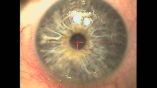 Corneal scar to 2020 Advanced Laser technique for HERPES Corneal scar to Gulani Vision [upl. by Htaeh]