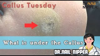 What is under the Callus Callus Tuesday 30 [upl. by Aicnatsnoc]