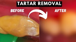 Huge TARTAR REMOVAL From Teeth  TEETH CLEANING [upl. by Notnirb]