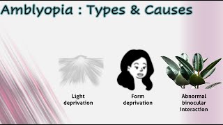 Amblyopia 1│ Types amp causes [upl. by Parthena854]