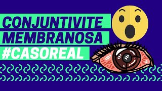 Conjuntivite membranosa 😳  CASO REAL  drolho [upl. by Orfurd]