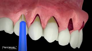 Avance vídeo completo quotCirugía múltiples recesiones gingivales adyacentes mediante itc en túnelquot [upl. by Airenahs]