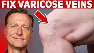 How to Treat Varicose Veins Naturally – Dr Berg [upl. by Naerb]