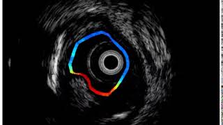 FLImIVUS pullback in diseased artery [upl. by Inanuah]