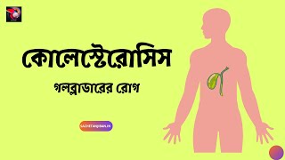 গলব্লাডারের রোগ কোলেস্টেরোসিস । Cholesterosis Of Gallbladder Bangla [upl. by Southard]