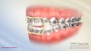 Elastics  Anterior Box  Orthodontic Treatment  Open Bite [upl. by Rennob857]