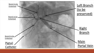 MSC Portal Vein Embolization [upl. by Ansev]