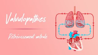 Rétrécissement mitral  Physiopathologie [upl. by Lash291]