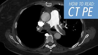 How to Read a CTA of the Chest Pulmonary Embolism Protocol [upl. by Hoashis921]