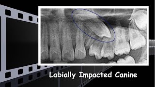 Orthodontically erupted of a labially impacted canine [upl. by Silda]