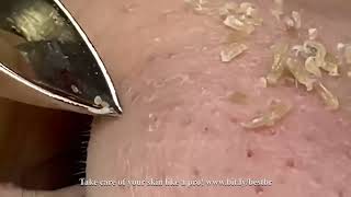 Satisfying Pimple Popping Compilation 2024  bitlybestbr [upl. by Nnaarat]