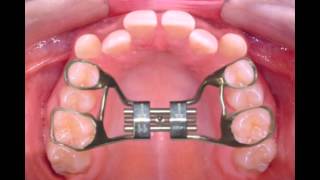 Rapid Palatal Expander [upl. by Shafer]