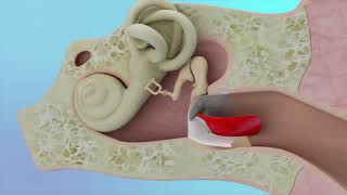 Eardrum Hole Repair Animation [upl. by Olaznog]