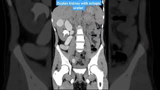 CT scan case 68 Duplex kidney with ectopic ureter ctscan radiology radiologist medicalimaging [upl. by Previdi]