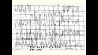 Wolff Parkinson White syndrome WPW [upl. by Ahsiak]