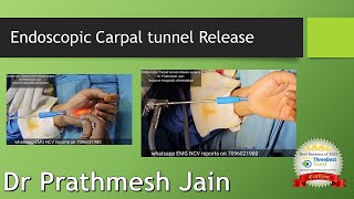 Endoscopic Carpal Tunnel Release Demonstration in English [upl. by Yllehs152]