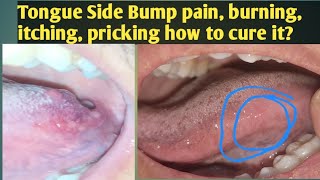 Tongue Side Bump painingHow to Cure Tongue papillae irritationTongue side bump is Itchy pricking [upl. by Enyahc]