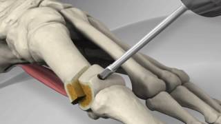 First Metatarsal Distal Chevron Osteotomy with Arthrex® LPS Screw [upl. by Navonoj]